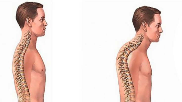 Duruş Bozukluğu İçin Pilates